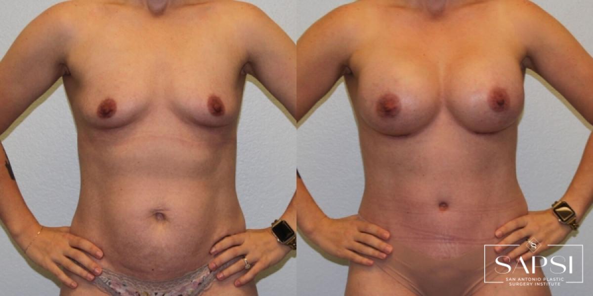 Mommy Makeover: Patient 47 - Before and After 