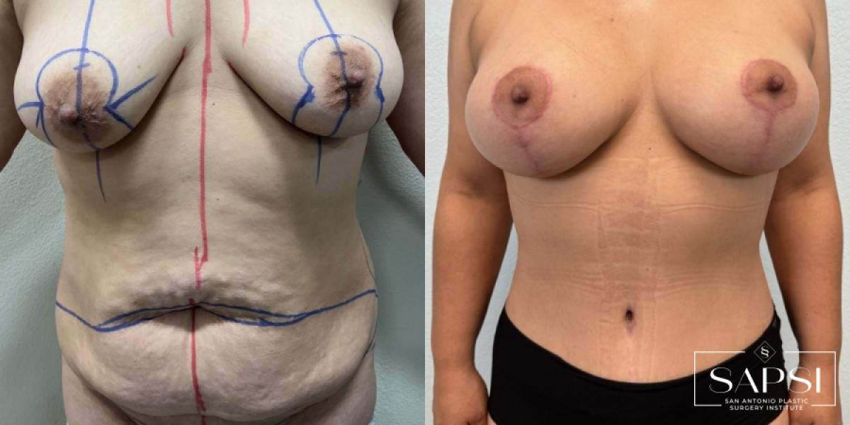 Mommy Makeover: Patient 4 - Before