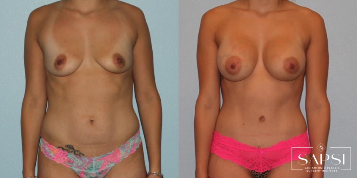 Mommy Makeover: Patient 11 - Before and After 