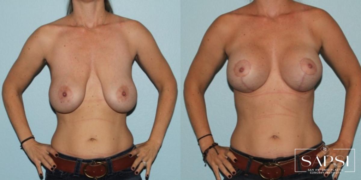 Breast Augmentation With Lift: Patient 19 - Before and After 