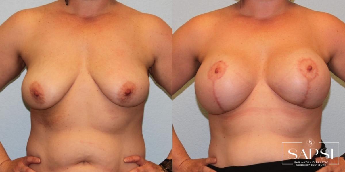 Breast Augmentation With Lift: Patient 3 - Before