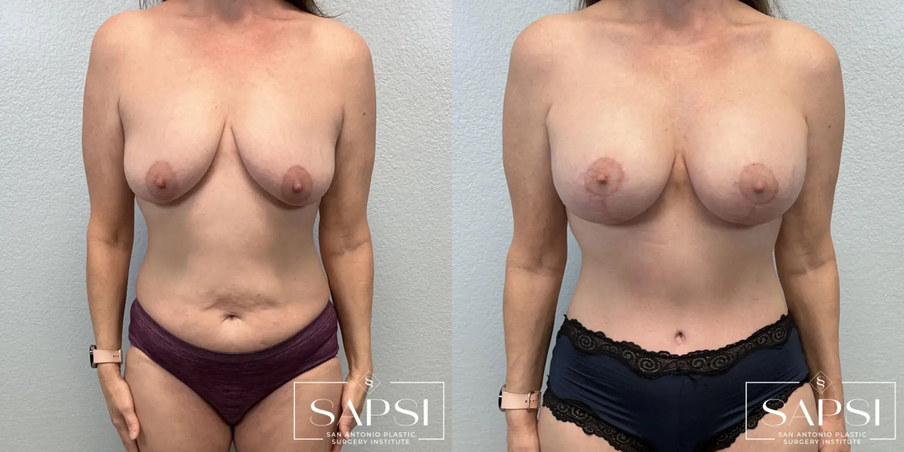Mommy Makeover: Patient 3 - Before and After
