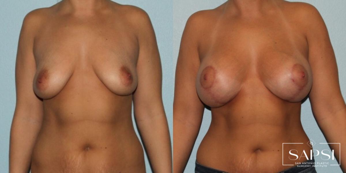 Breast Augmentation With Lift: Patient 21 - Before and After 