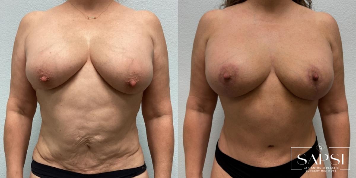 Mommy Makeover: Patient 6 - Before