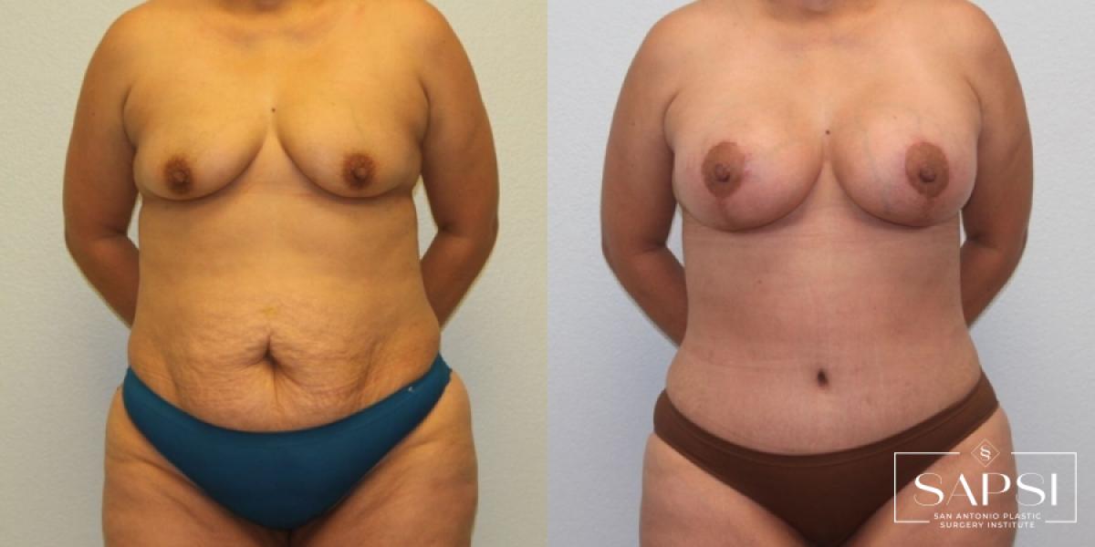 Breast Augmentation With Lift: Patient 17 - Before and After 