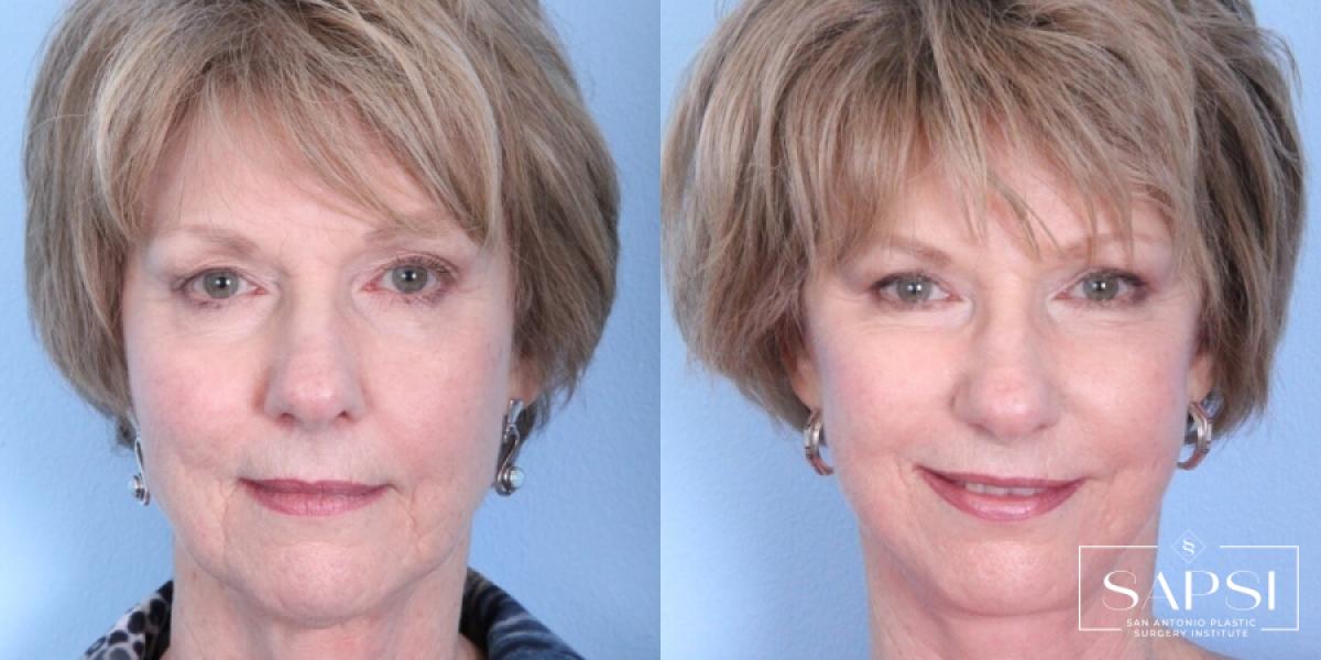 Eyelid Surgery: Patient 2 - Before