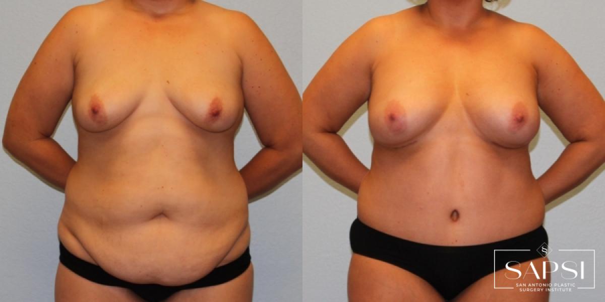 Mommy Makeover: Patient 13 - Before and After 