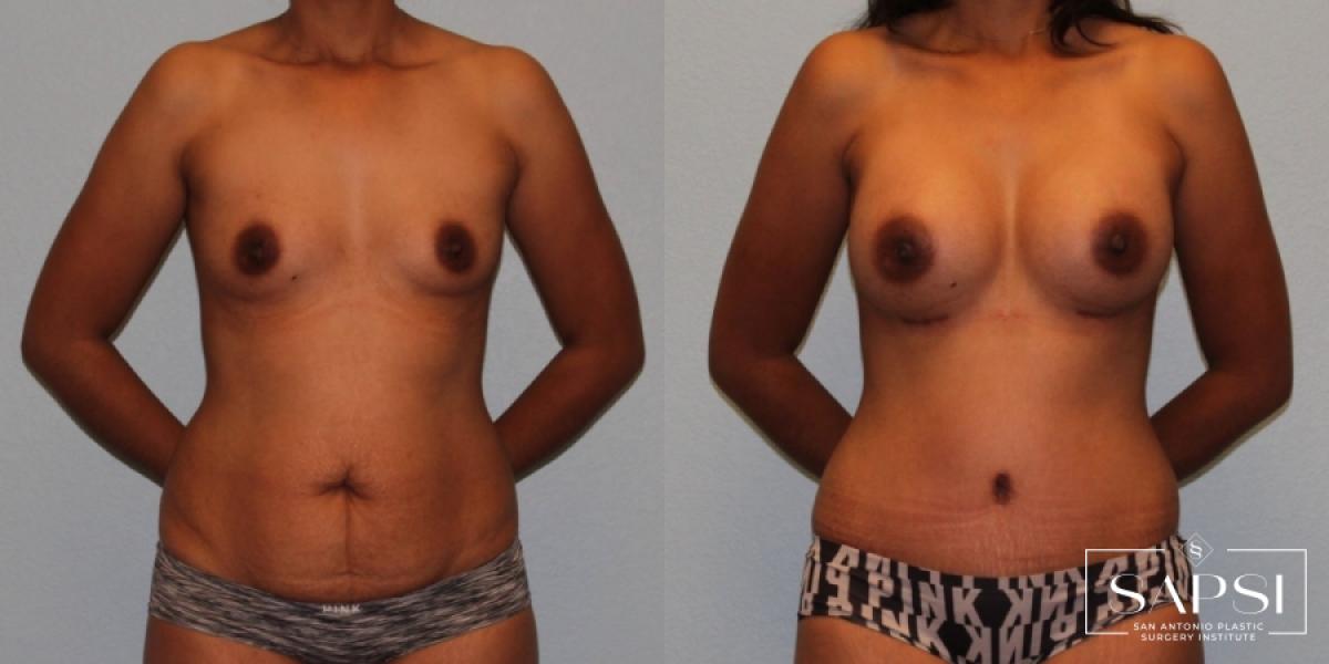 Mommy Makeover: Patient 18 - Before and After 