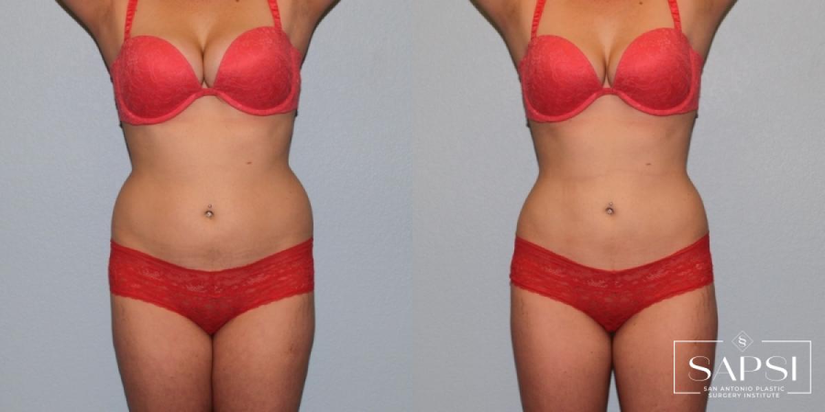 Body Contouring: Patient 1 - Before