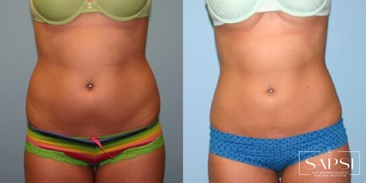 Body Contouring: Patient 2 - Before