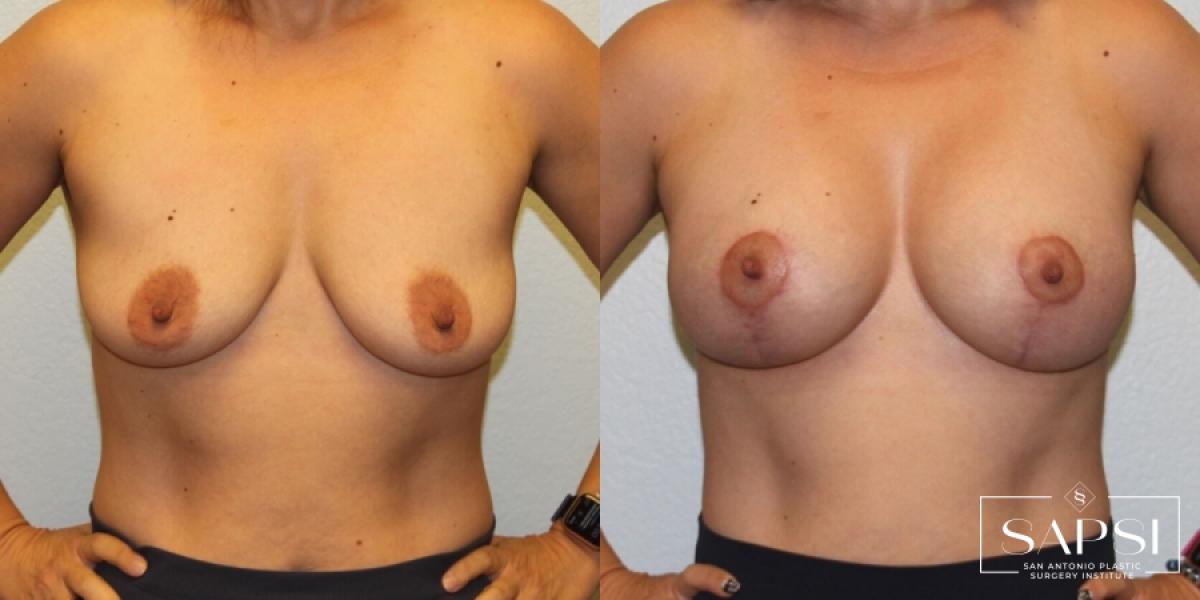 Breast Augmentation With Lift: Patient 4 - Before