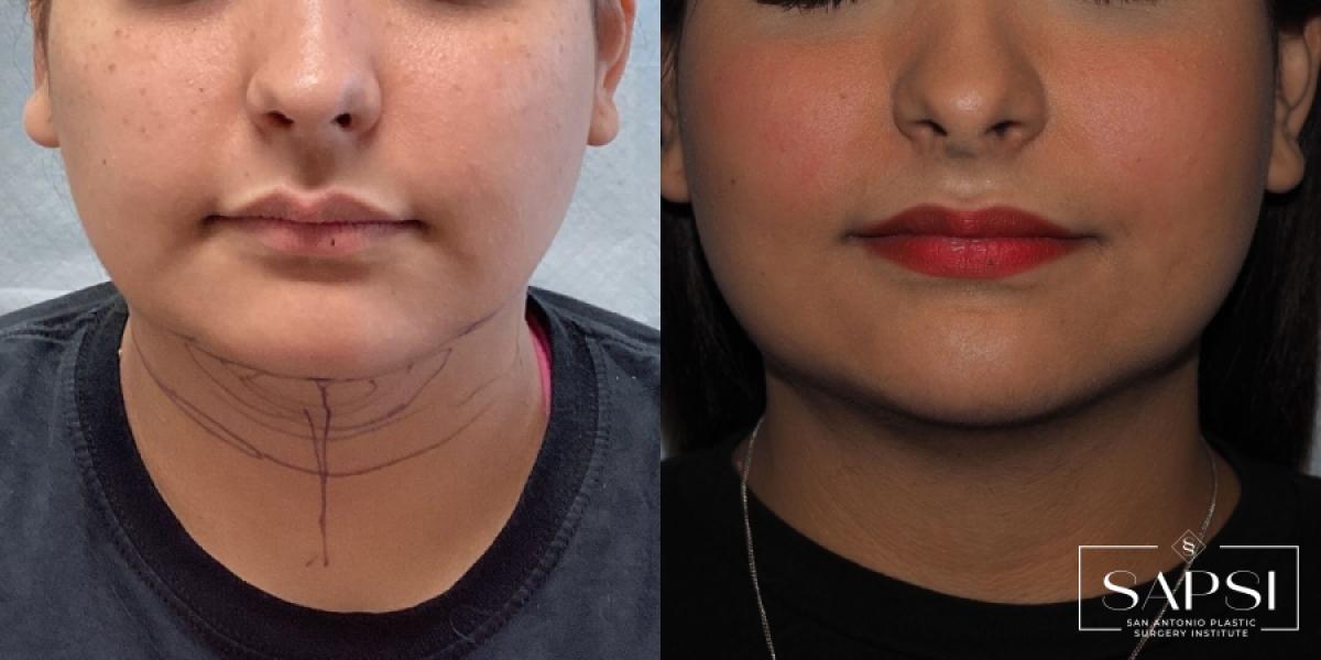 Liposuction: Patient 3 - Before