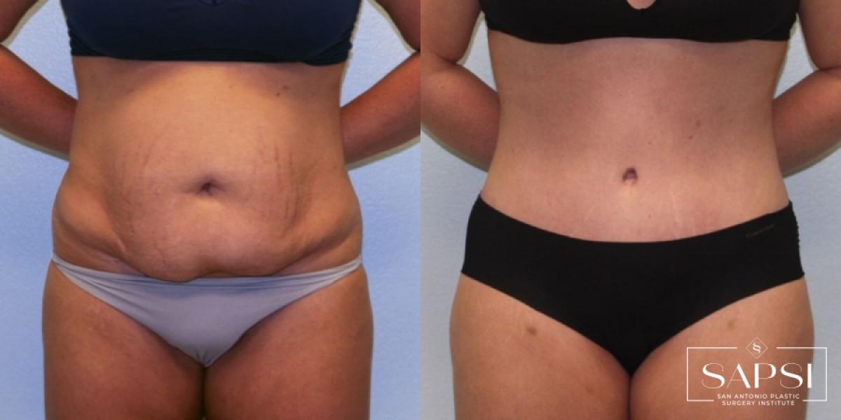 Tummy Tuck: Patient 9 - Before