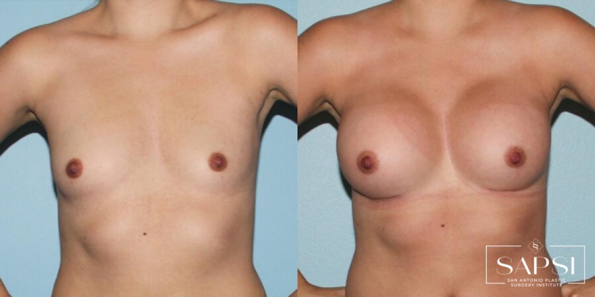 Breast Augmentation: Patient 9 - Before