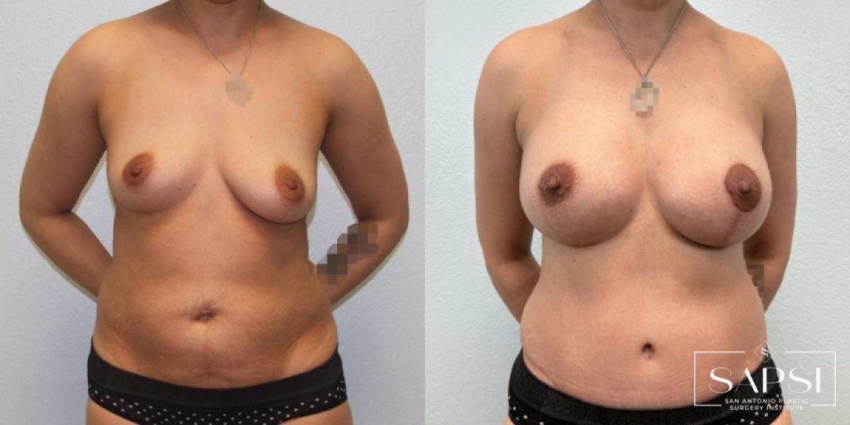 Mommy Makeover: Patient 7 - Before
