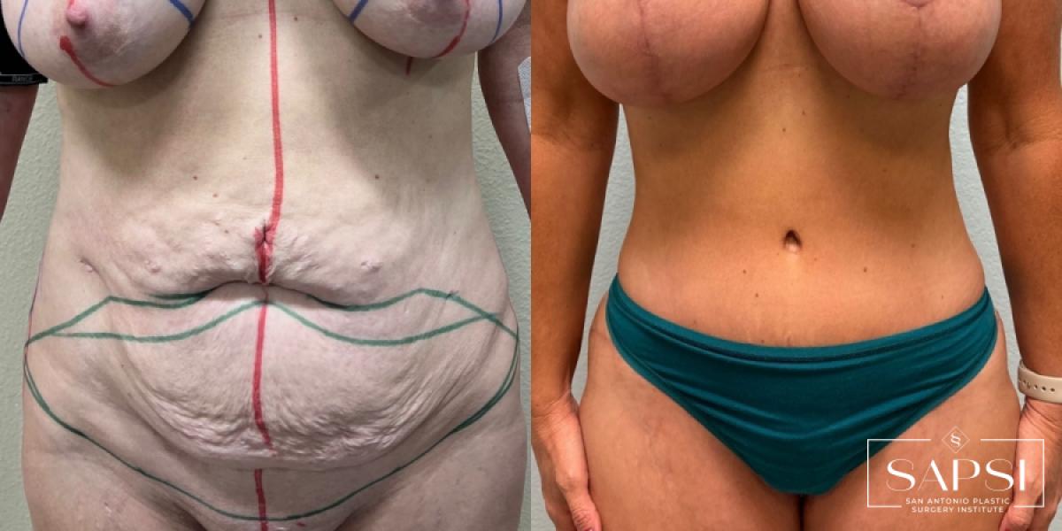 Tummy Tuck: Patient 1 - Before