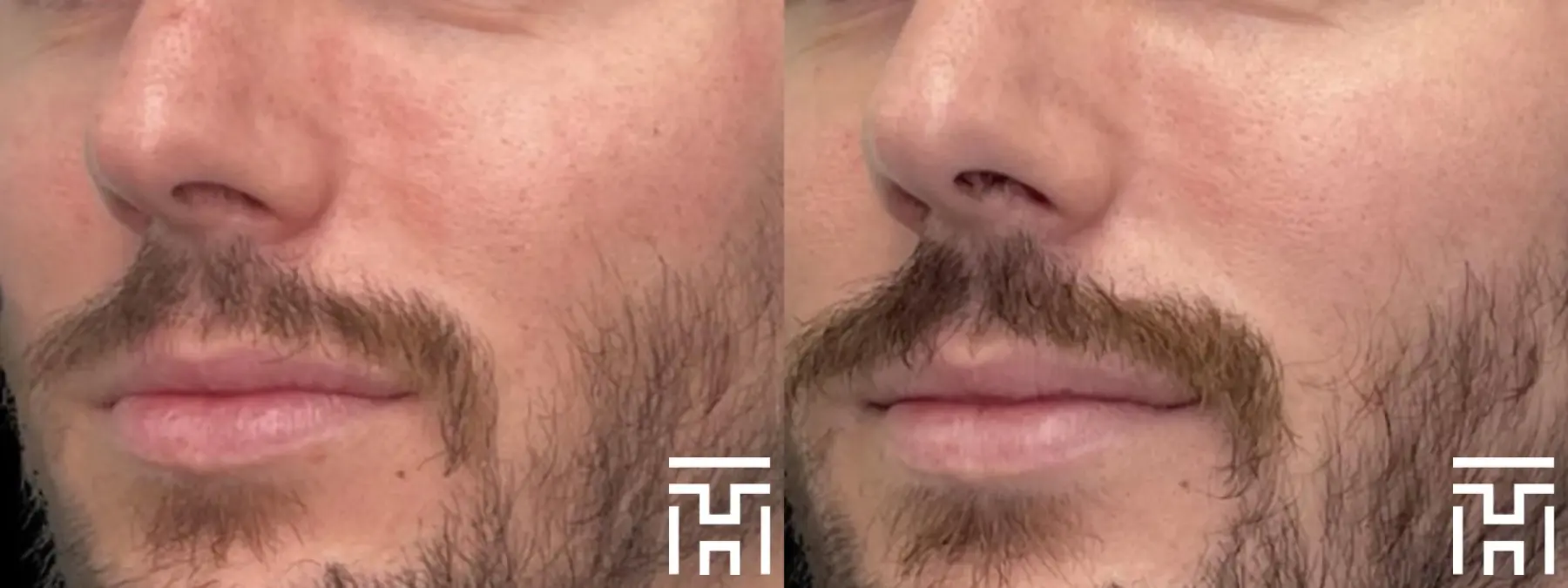BBL® By Sciton: Patient 12 - Before and After  