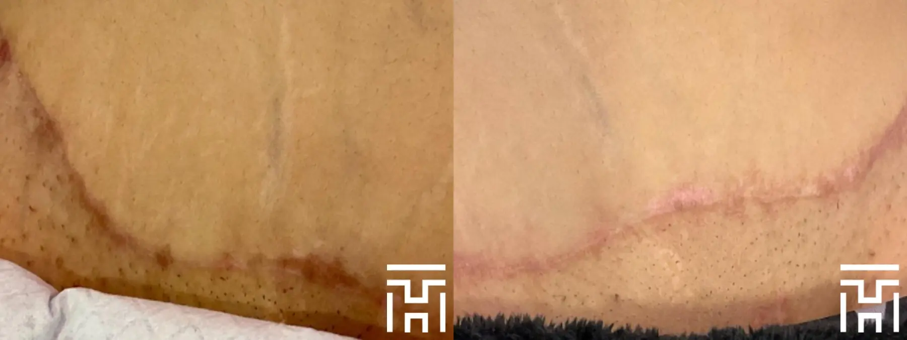 BBL® By Sciton: Patient 11 - Before and After  