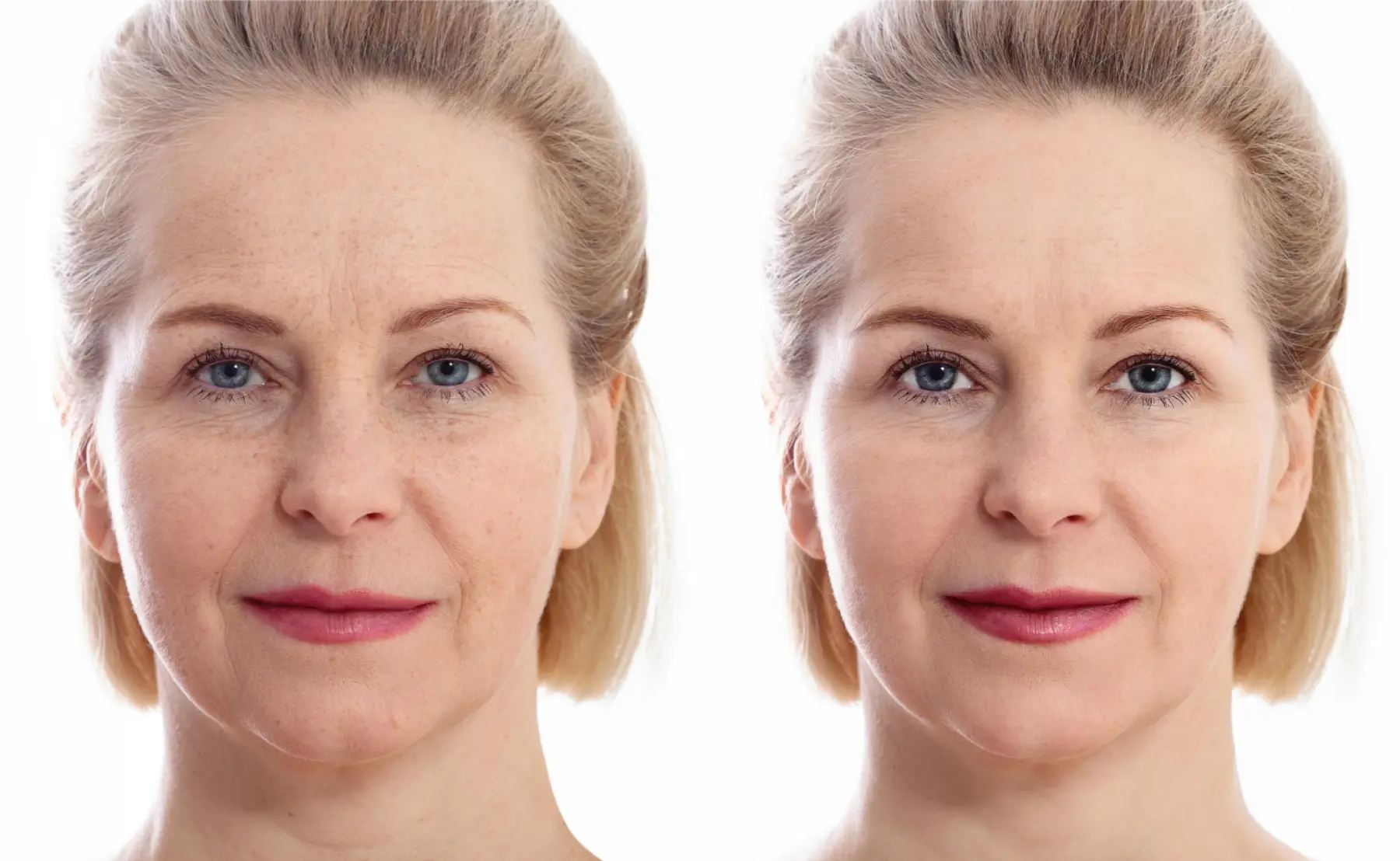 Acne Rejuvenation: Patient 2 - Before and After  