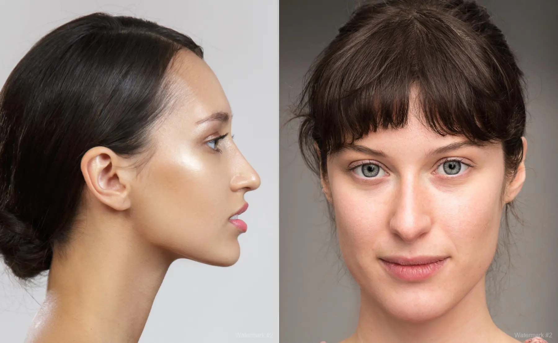 Acne Rejuvenation: Patient 1 - Before and After  
