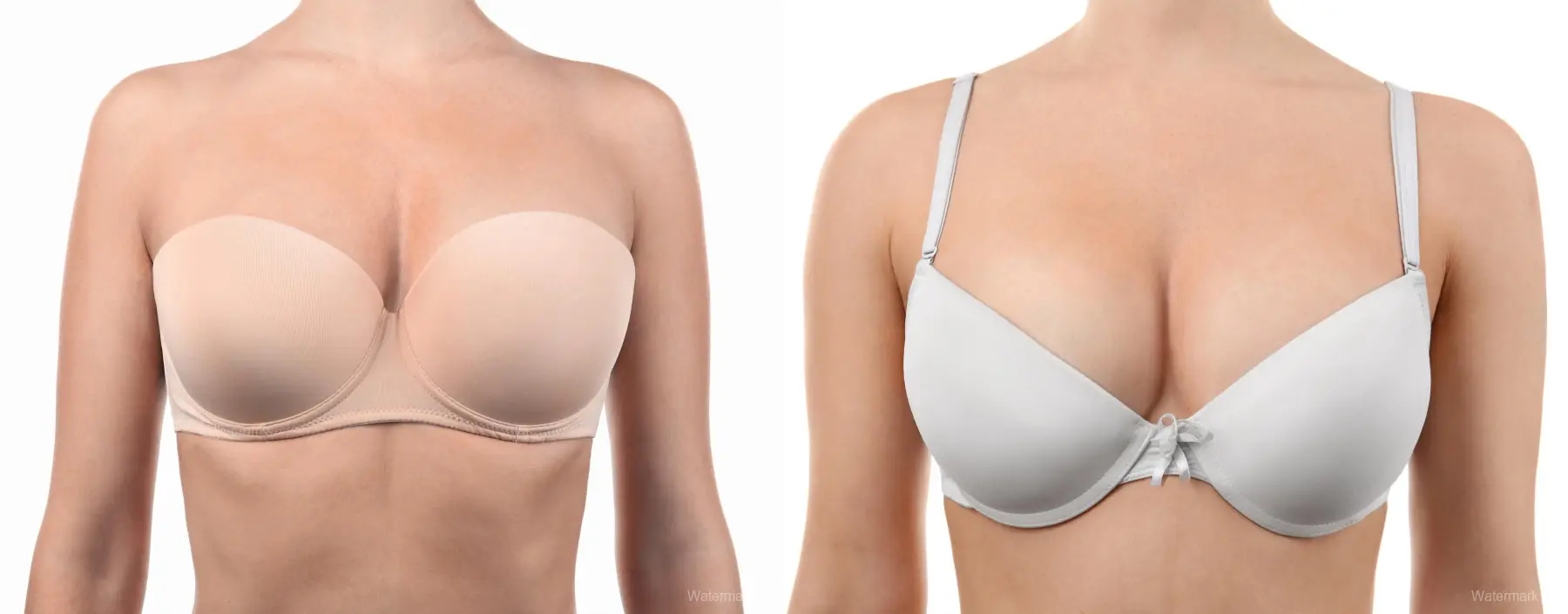 Breast Augmentation: Patient 2 - Before and After 1