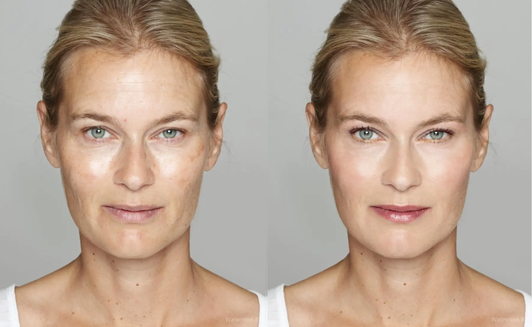 Facelift: Patient 1 - Before and After  