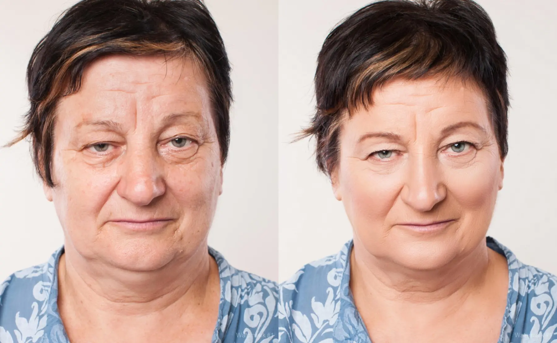Facelift: Patient 1 - Before and After 5