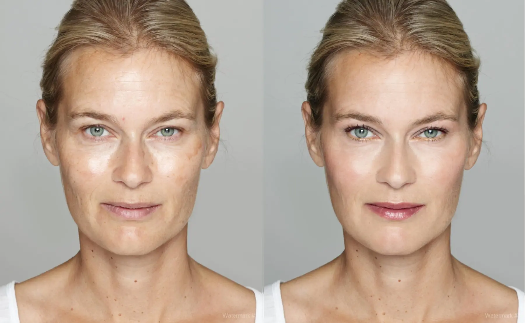 Fillers: Patient 1 - Before and After  