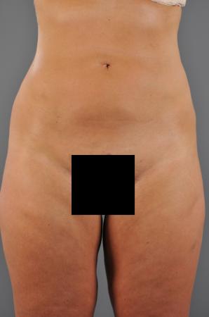 After Image 1