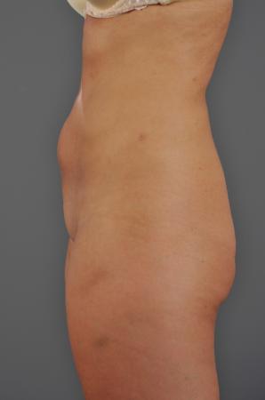 After Image 2