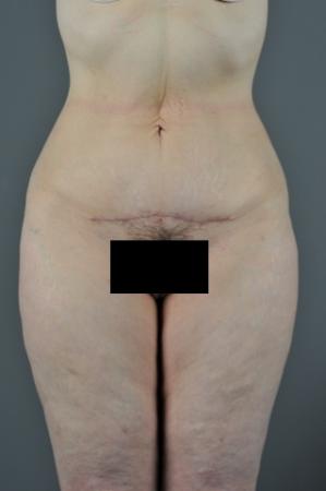 After Image 1