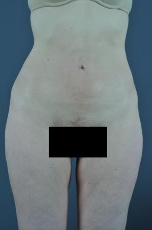 After Image 1
