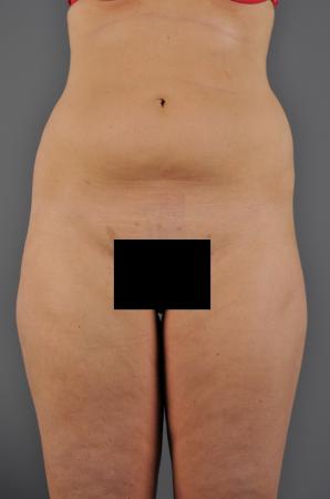 Before Image 1