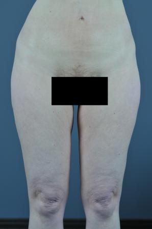 After Image 5