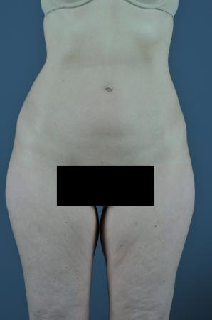 Before Image 1