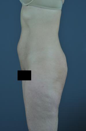 Before Image 2