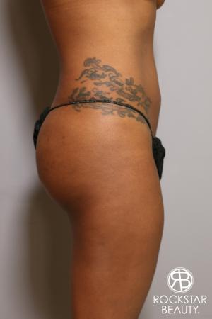 Brazilian Butt Lift: Patient 10 - Before Image 3