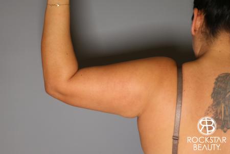 Liposuction: Patient 12 - After Image 3