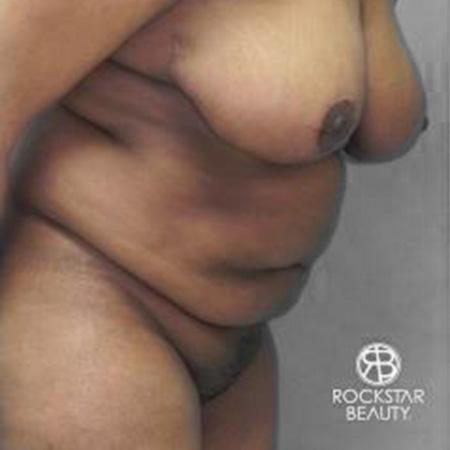 Tummy Tuck: Patient 9 - Before and After 3