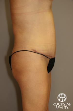 Tummy Tuck: Patient 1 - After Image 3