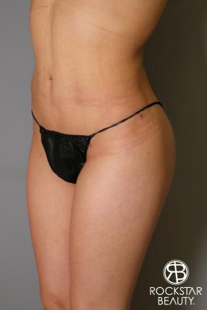 Liposuction: Patient 14 - After Image 1
