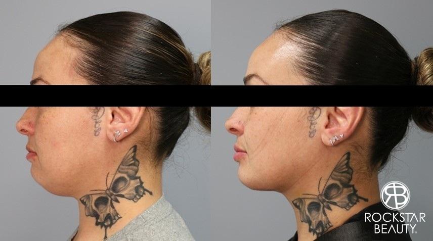Liposuction Of The Neck: Patient 5 - Before and After  