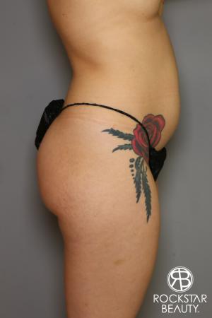 Brazilian Butt Lift: Patient 18 - Before Image 3