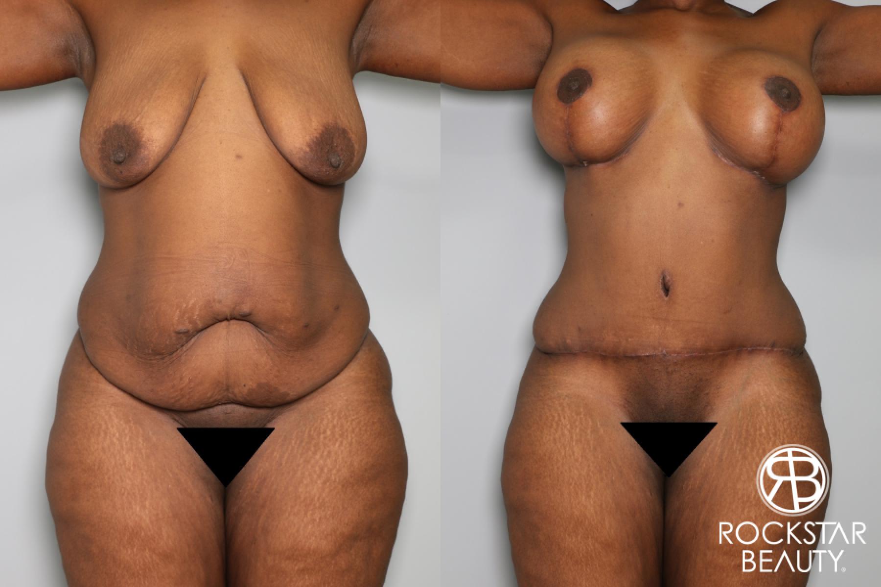 Tummy Tuck: Patient 5 - Before and After 1