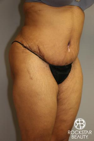 Tummy Tuck: Patient 3 - After Image 2
