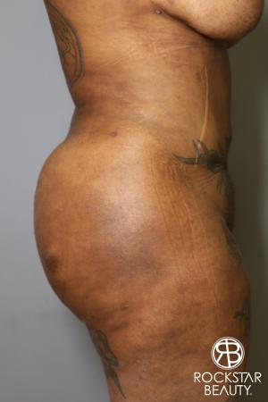 Brazilian Butt Lift: Patient 15 - After Image 5