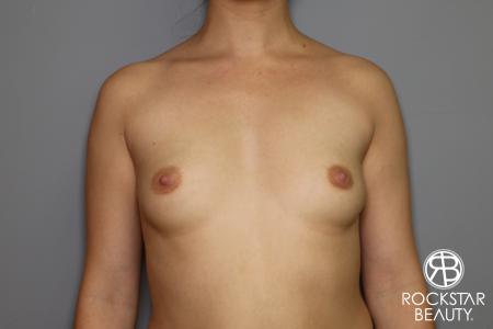 Breast Augmentation: Patient 16 - Before Image 1