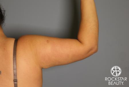 Liposuction: Patient 12 - After Image 4