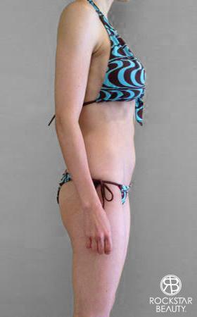 Liposuction: Patient 8 - After 2