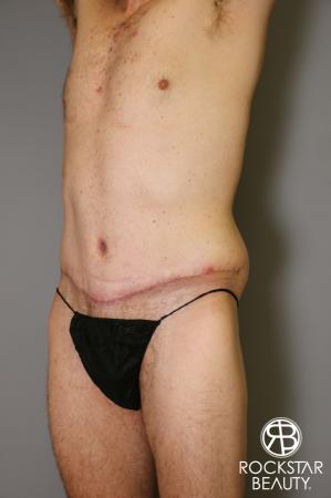 Tummy Tuck: Patient 11 - After Image 4